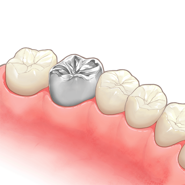クラウン　被せ物