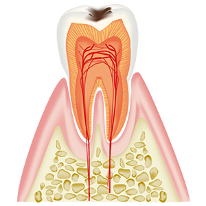 エナメル質内のむし歯