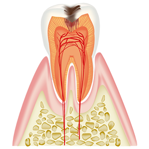 象牙質に達したむし歯