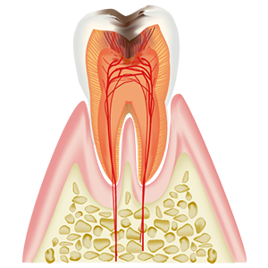神経 （歯髄）に達したむし歯