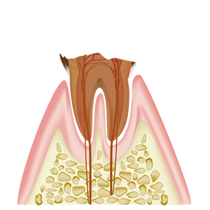 歯質が失われたむし歯