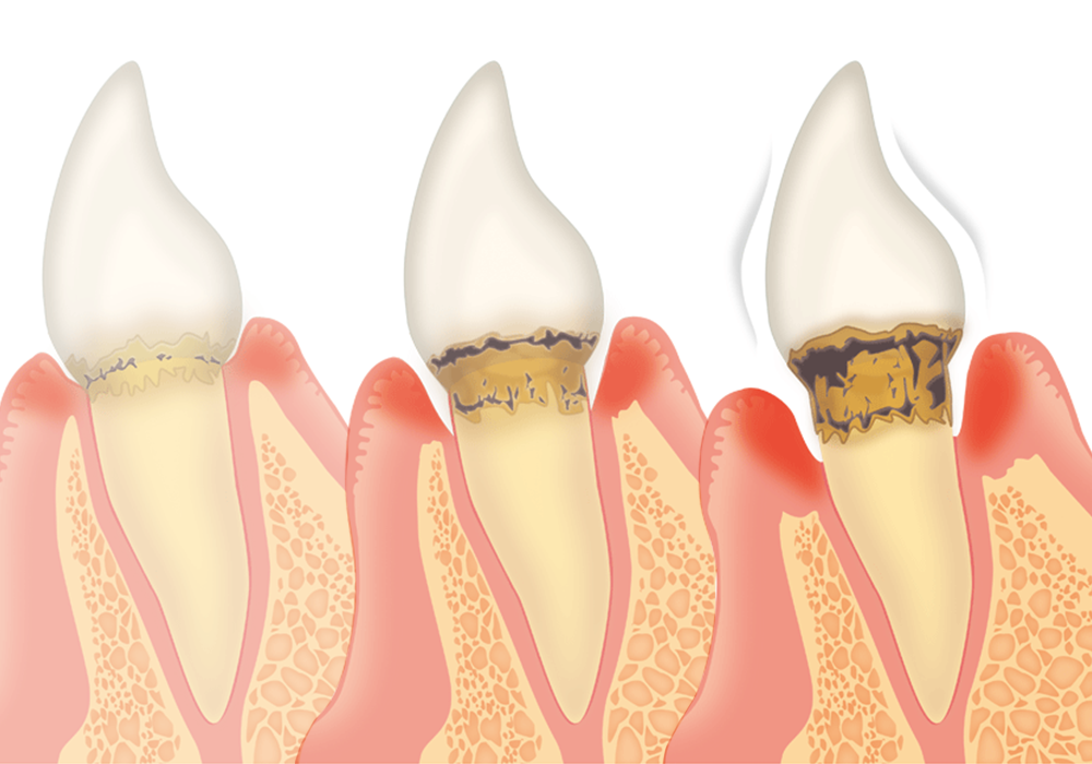 歯周病