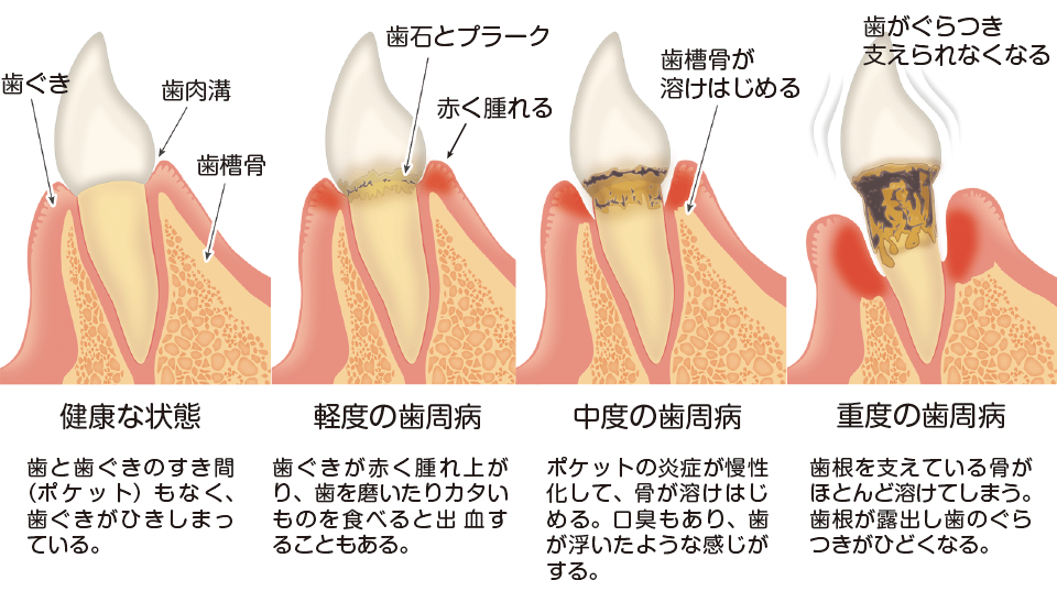 歯周病の進行