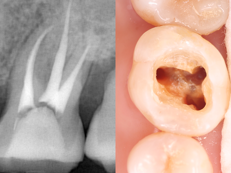 根管の様子