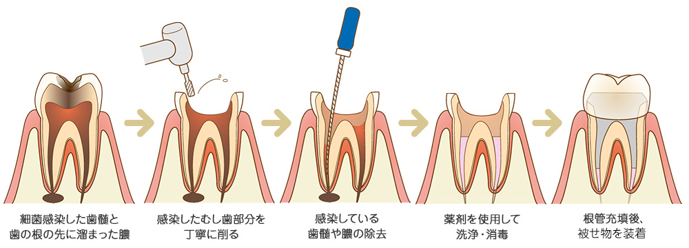 根管治療の流れ