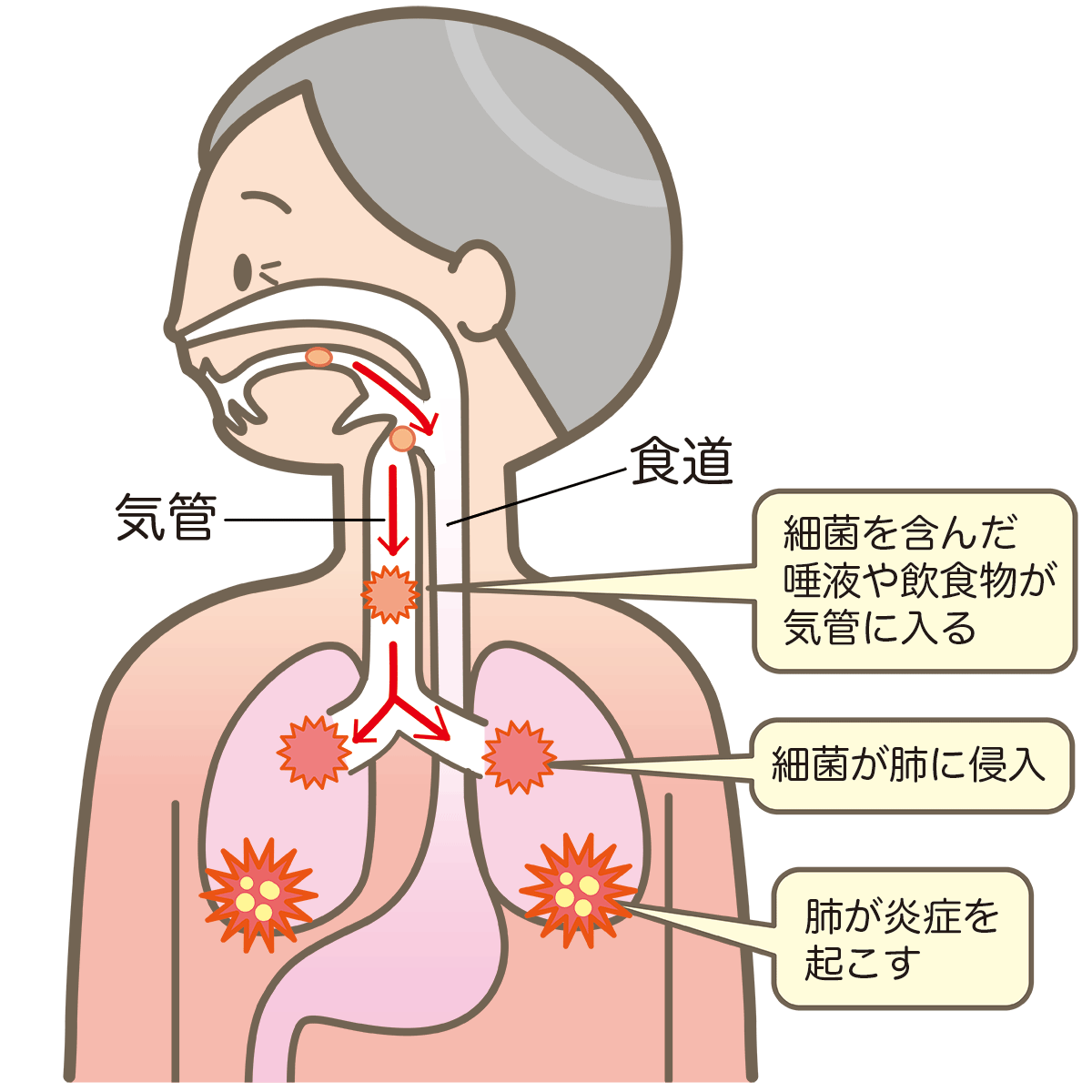 誤嚥性肺炎